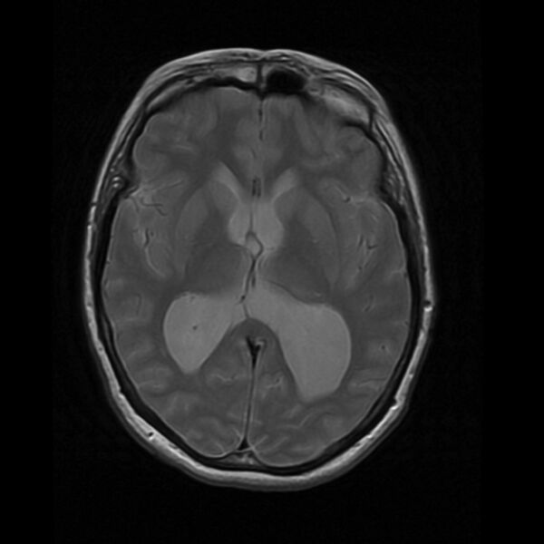 File:Colloid cyst with hydrocephalus (Radiopaedia 9373-10065 Axial PD 10).jpg