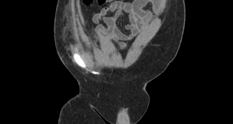 File:Colocutaneous fistula (Radiopaedia 56401-63062 C 14).jpg