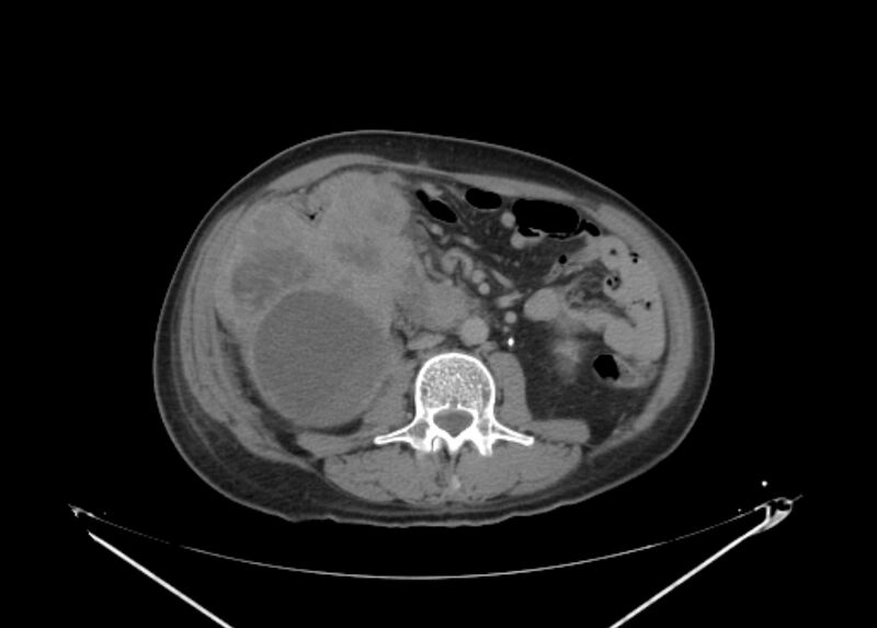 File:Colon cancer mimicking renal cell carcinoma (Radiopaedia 28986-29335 Axial C+ delayed 39).jpg