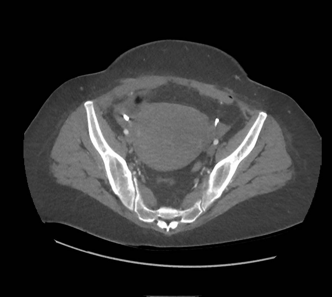 File:Colonic pseudo-obstruction (Radiopaedia 79752-92980 A 156).png
