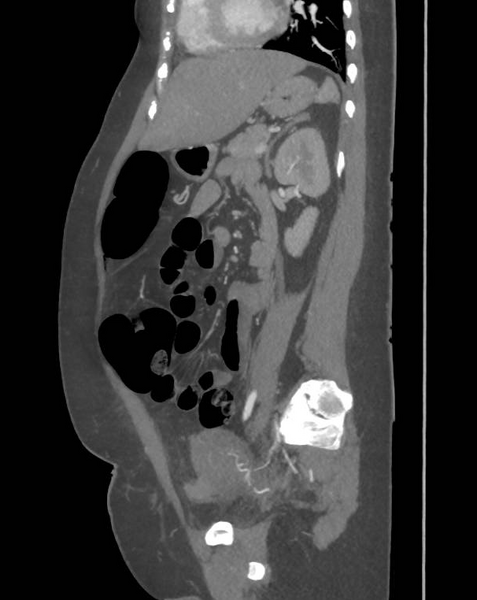 File:Colonic pseudo-obstruction (Radiopaedia 79752-92980 C 49).png