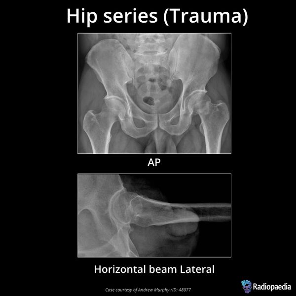 File:Hip series (trauma) (Radiopaedia 68588).jpeg