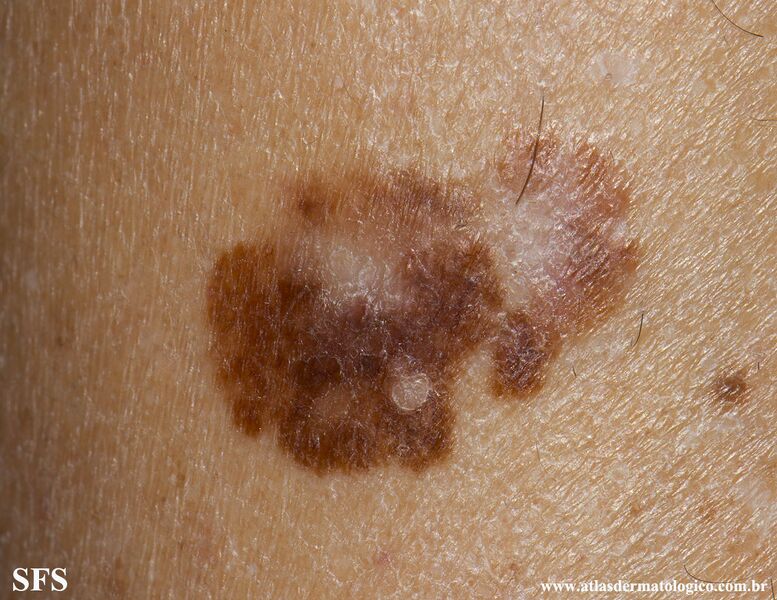 File:Melanoma (Dermatology Atlas 105).jpg