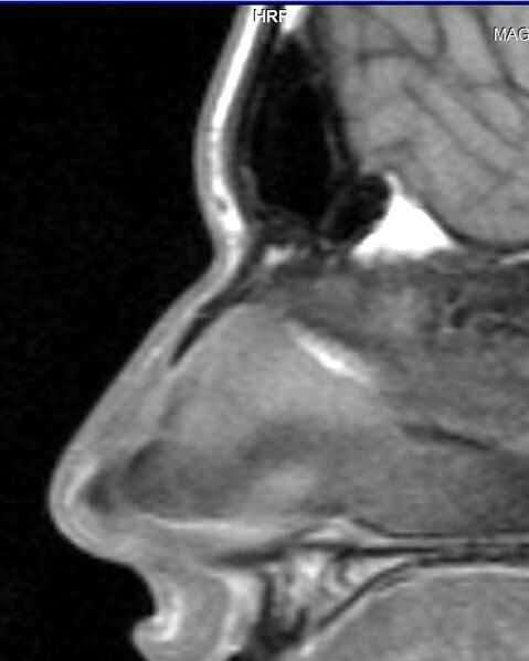 File:Nasal bone fracture (Radiopaedia 13141).jpg