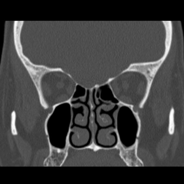 File:Nasolabial cyst (Radiopaedia 33987-35205 Coronal bone window 41).jpg