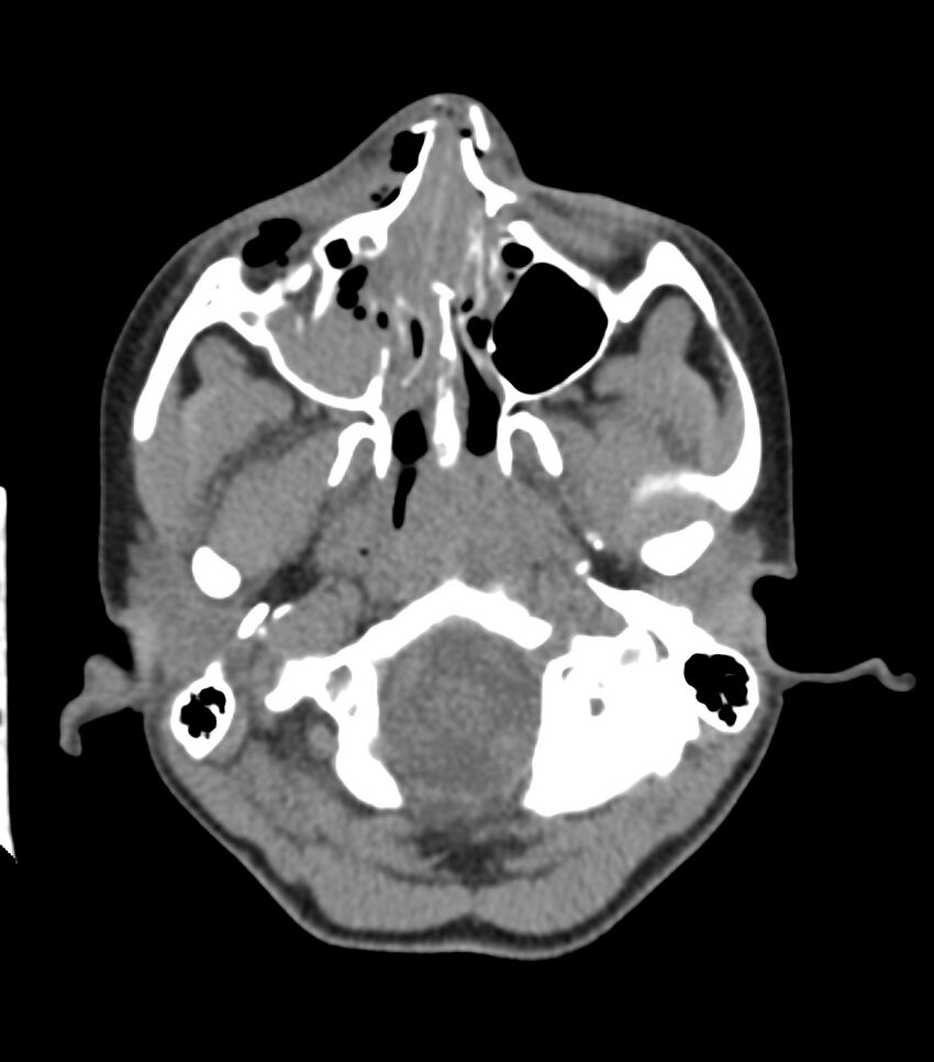 Nasoorbitoethmoid fracture (Radiopaedia 90044-107205 Axial non-contrast 135).jpg