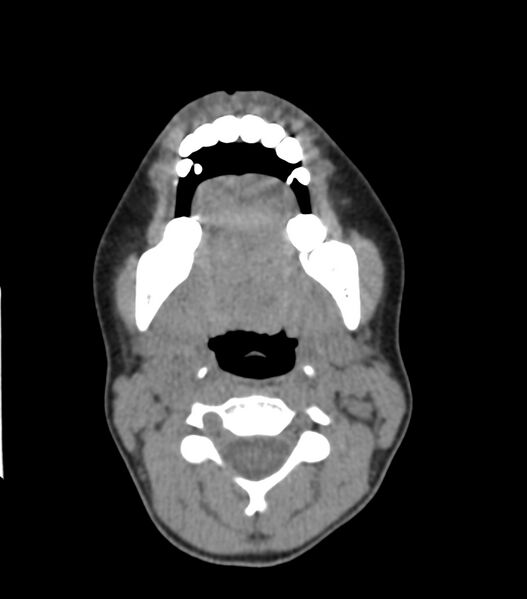 File:Nasoorbitoethmoid fracture (Radiopaedia 90044-107205 Axial non-contrast 70).jpg