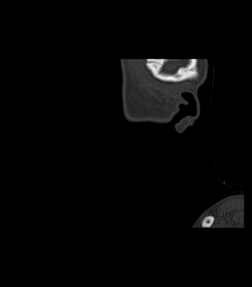 Nasoorbitoethmoid fracture (Radiopaedia 90044-107205 Sagittal bone window 137).jpg