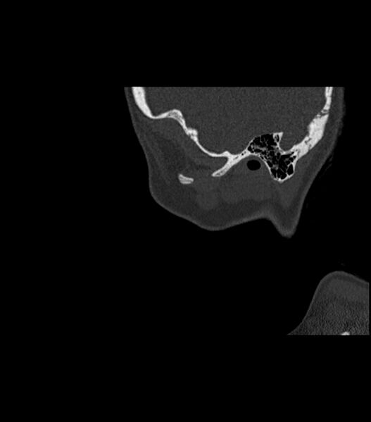 File:Nasoorbitoethmoid fracture (Radiopaedia 90044-107205 Sagittal bone window 20).jpg