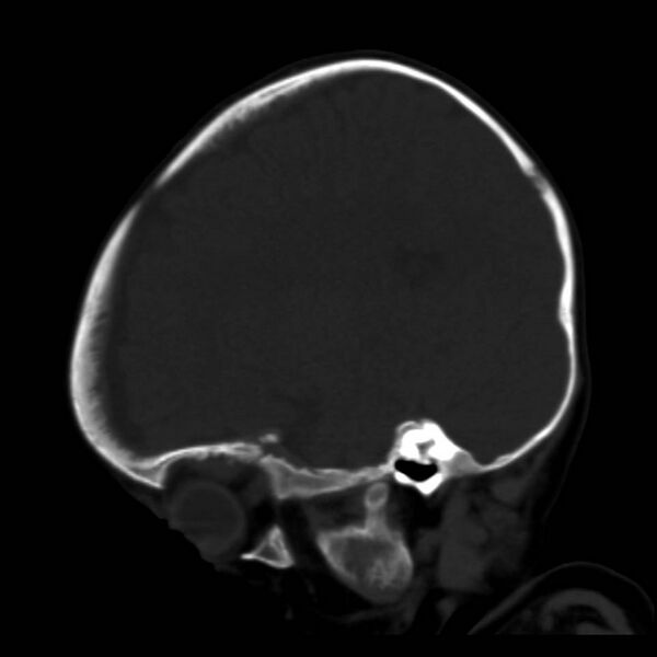 File:Neuroblastoma with skull metastases (Radiopaedia 30326-30958 Sagittal bone window 30).jpg
