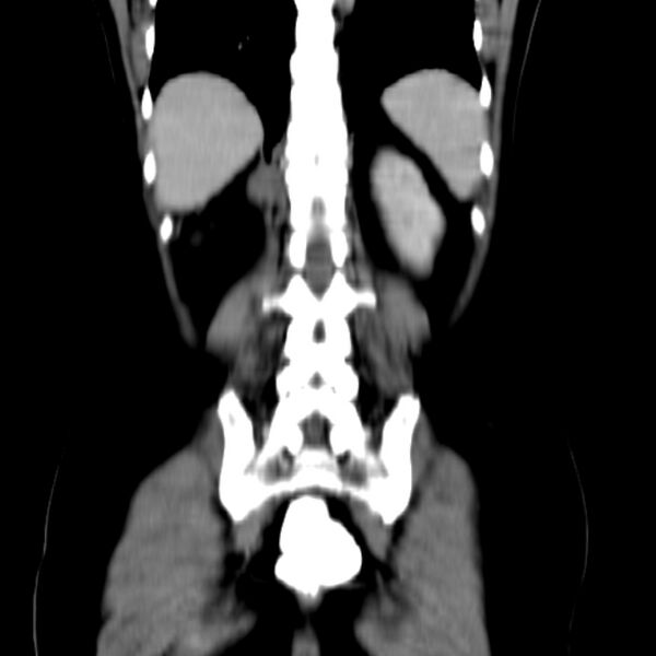 File:Neurofibroma - spine (Radiopaedia 27891-28125 B 24).jpg