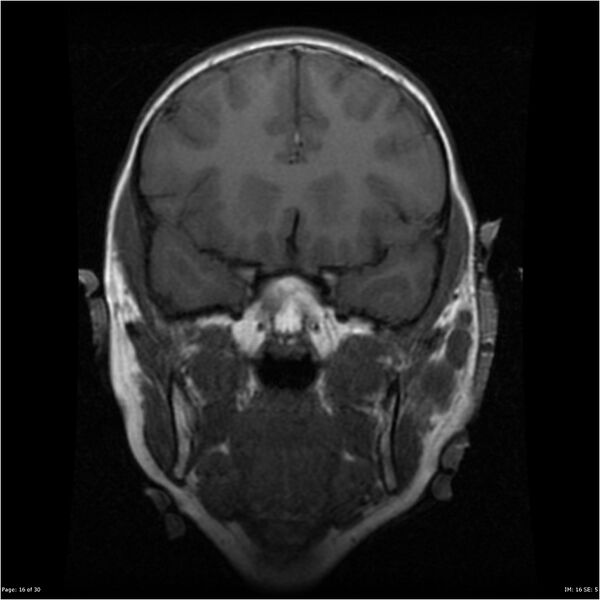 File:Neurofibromatosis type 1 (Radiopaedia 22541-22564 Coronal T1 25).jpg