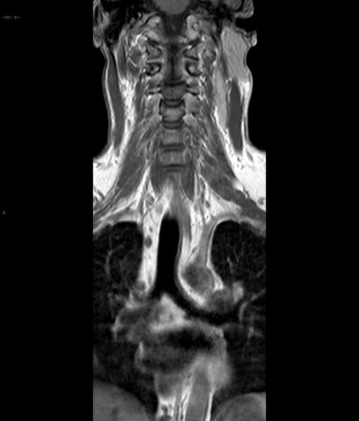 File:Neurofibromatosis type 1 (Radiopaedia 36933-38560 Coronal T1 8).jpg