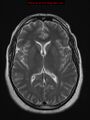 Neuroglial cyst (Radiopaedia 10713-11184 Axial T2 11).jpg