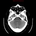 Neuroglial cyst (Radiopaedia 10713-11185 Axial non-contrast 24).jpg