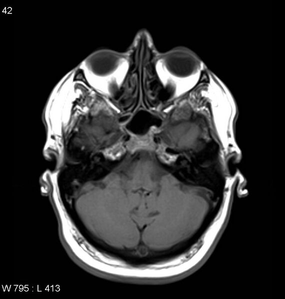 File:Neurosarcoidosis (Radiopaedia 10930-11351 Axial T1 4).jpg
