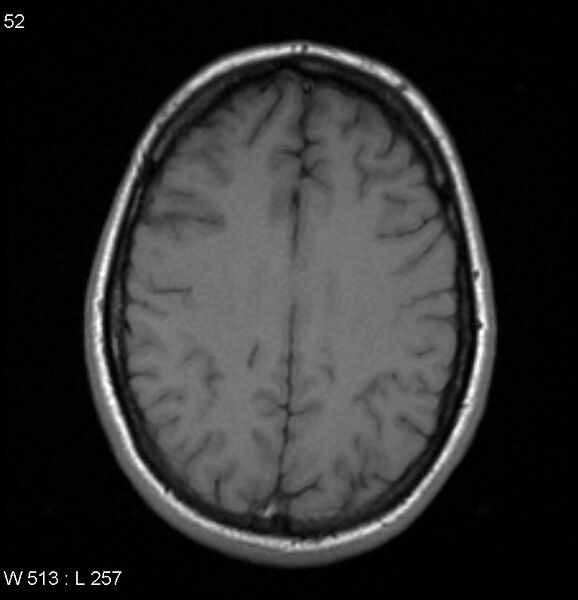 File:Neurosarcoidosis (Radiopaedia 10930-17204 Axial T1 14).jpg