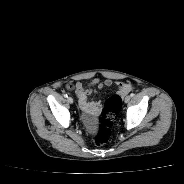 File:Non small-cell lung cancer (Radiopaedia 24467-24769 C+ delayed 107).jpg