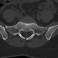 Normal CT lumbar spine (Radiopaedia 53981-60118 Axial bone window 66).jpg
