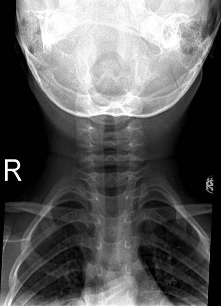 File:Normal cervical spine radiographs - 2-year-old (Radiopaedia 53360-59340 Frontal 1).jpeg