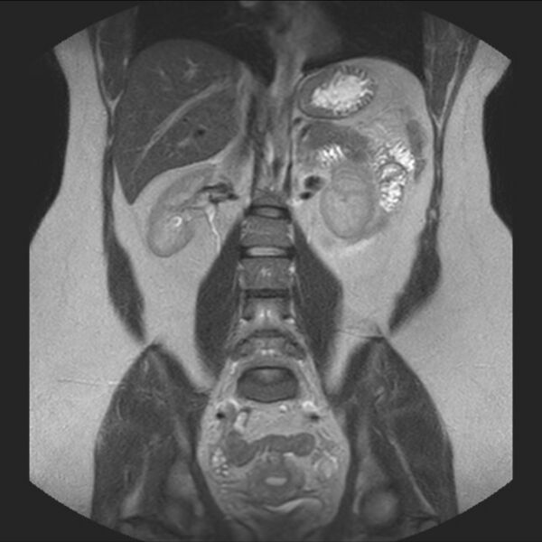 File:Normal liver MRI with Gadolinium (Radiopaedia 58913-66163 Coronal T2 25).jpg