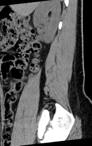 File:Normal lumbar spine CT (Radiopaedia 46533-50986 C 90).png