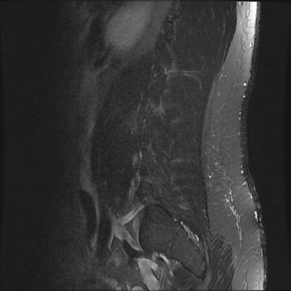 File:Normal lumbar spine MRI (Radiopaedia 43051-46311 Sagittal STIR 19).jpg