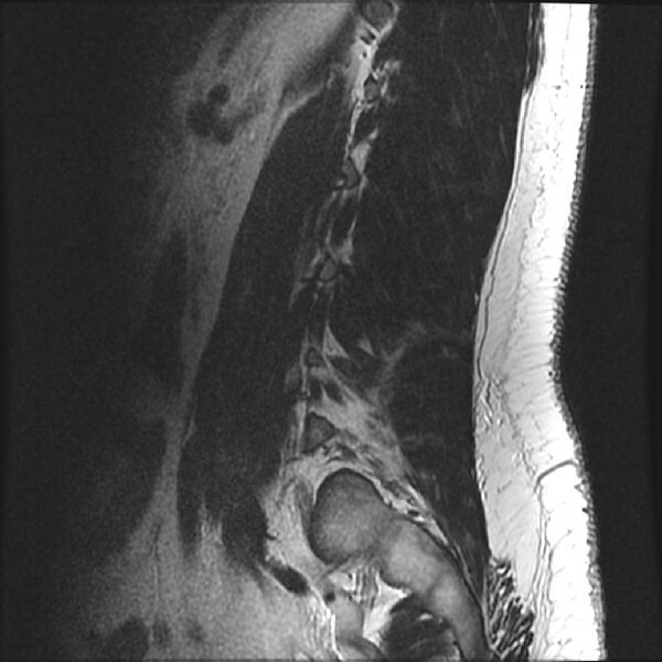 File:Normal lumbar spine MRI (Radiopaedia 43051-46311 Sagittal T2 3).jpg