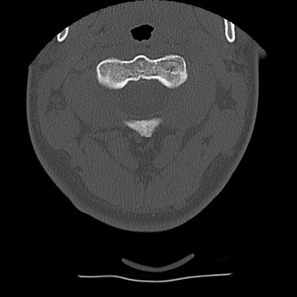 File:Normal trauma spine imaging (Radiopaedia 31753-32686 Axial bone window 16).jpg