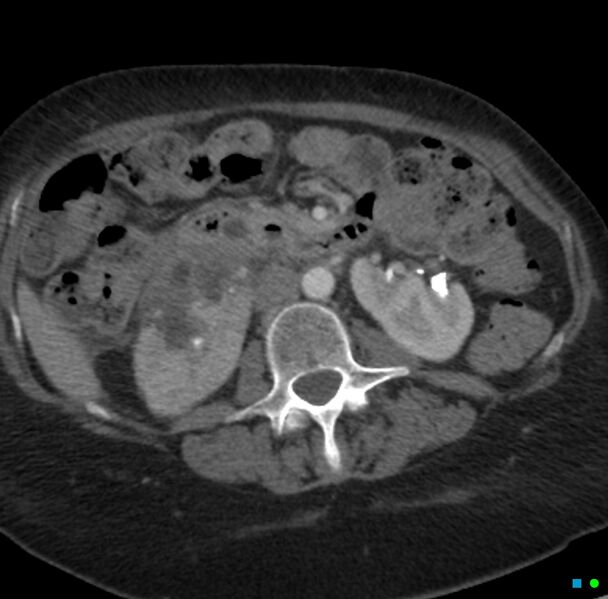 File:Obstructed infected horseshoe kidney (Radiopaedia 18116-17898 B 12).jpg