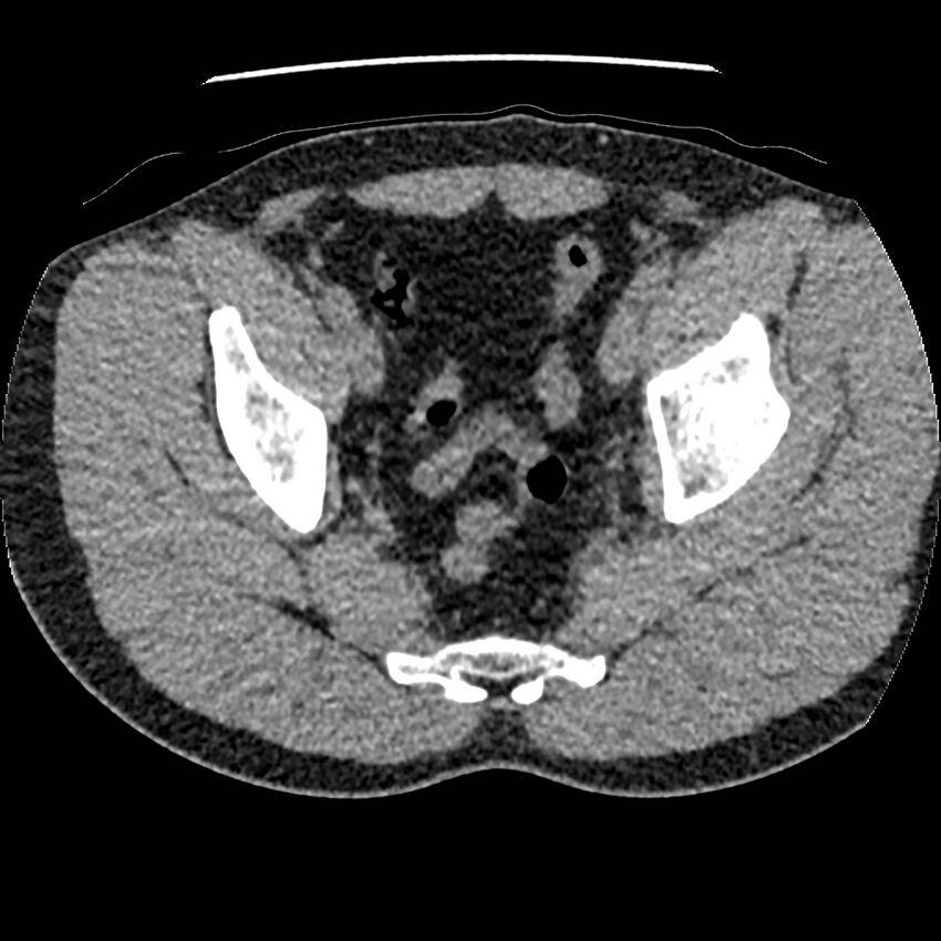 Obstructing ureteric calculus and ureteric anatomy (Radiopaedia 62730-71042 Axial non-contrast 145).jpg