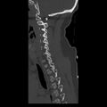 Occipital condyle fracture (Radiopaedia 31755-32691 Sagittal bone window 12).jpg