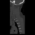 Occipital condyle fracture (Radiopaedia 31755-32691 Sagittal bone window 36).jpg