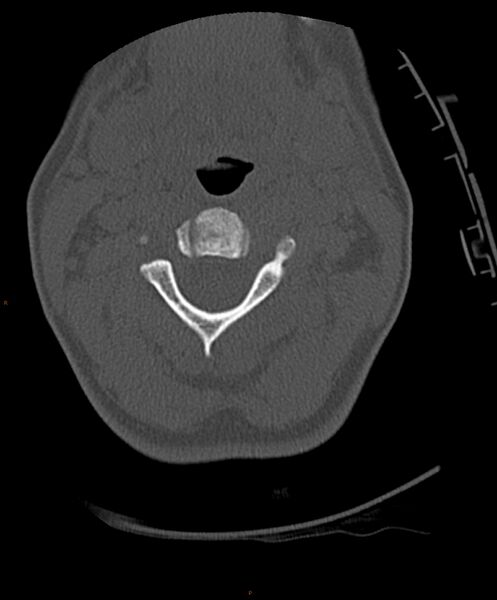 File:Occipital condyle fracture (Radiopaedia 61165-69056 D 13).jpg