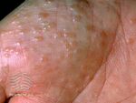 Pompholyx (DermNet NZ dermatitis-pompholyx-3529).jpg