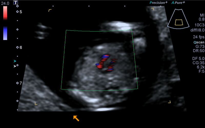 File:1st trimester nuchal-morphology ultrasound (Radiopaedia 44706-48477 Heart views cine with colour 125).jpg