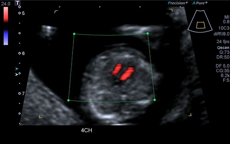 File:1st trimester nuchal-morphology ultrasound (Radiopaedia 44706-48477 Heart views cine with colour 40).jpg