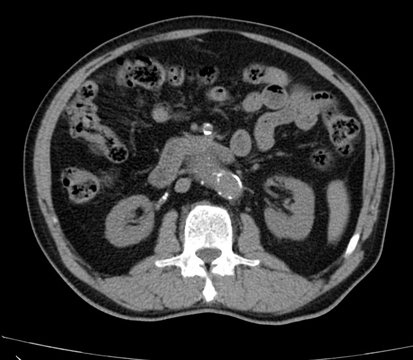 Abdominal aortic aneurysm (Radiopaedia 22421-22458 non-contrast 23).jpg