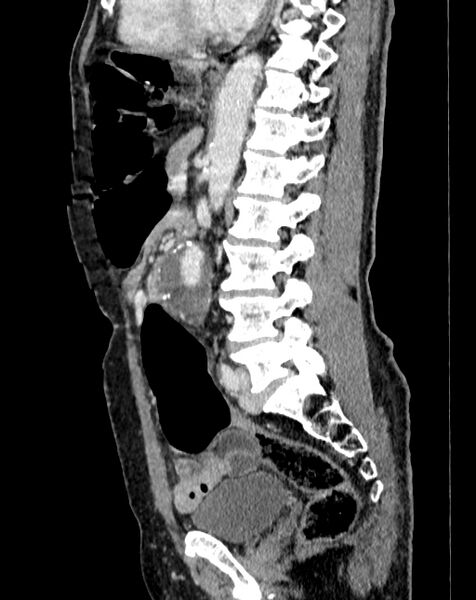 File:Abdominal aortic aneurysm (Radiopaedia 83581-98689 Sagittal C+ portal venous phase 63).jpg