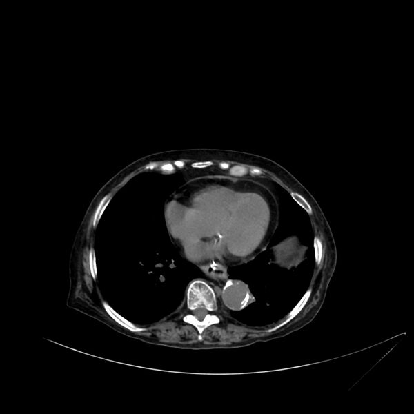 File:Abdominal aortic aneurysm - impending rupture (Radiopaedia 19233-19246 Axial non-contrast 11).jpg