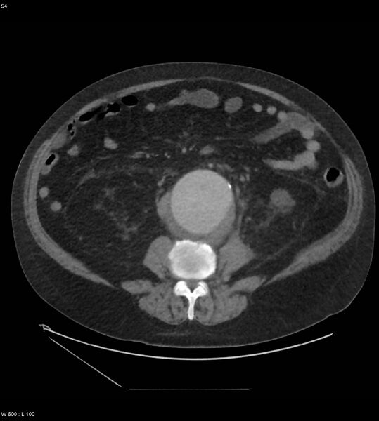 File:Abdominal aortic aneurysm with intramural hematoma then rupture (Radiopaedia 50278-55631 Axial C+ arterial phase 85).jpg