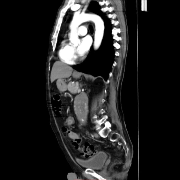 File:Abdominal aortic interposition tube graft and aneurysm thrombosis (Radiopaedia 71438-81857 Sagittal C+ arterial phase 13).jpg