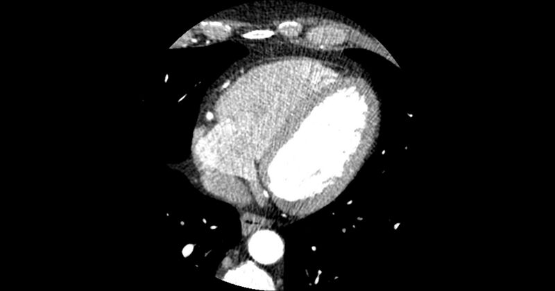File:Aberrant left main coronary artery (ALMCA) arising from the right sinus with interarterial course (Radiopaedia 63251-71814 Axial C+ arterial phase 142).JPG