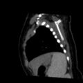 Aberrant left pulmonary artery (pulmonary sling) (Radiopaedia 42323-45435 Sagittal C+ arterial phase 47).jpg