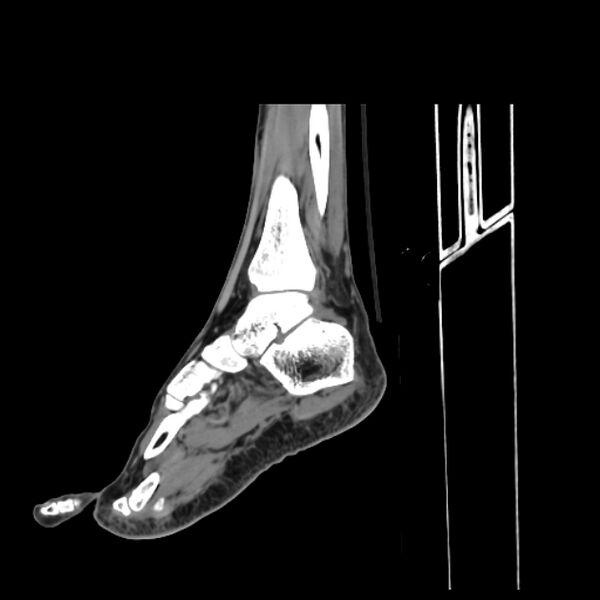 File:Accessory soleus muscle (Radiopaedia 61069-68943 C 19).jpg