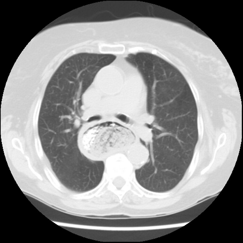 Achalasia (Radiopaedia 44094-47649 Axial lung window 25).jpg