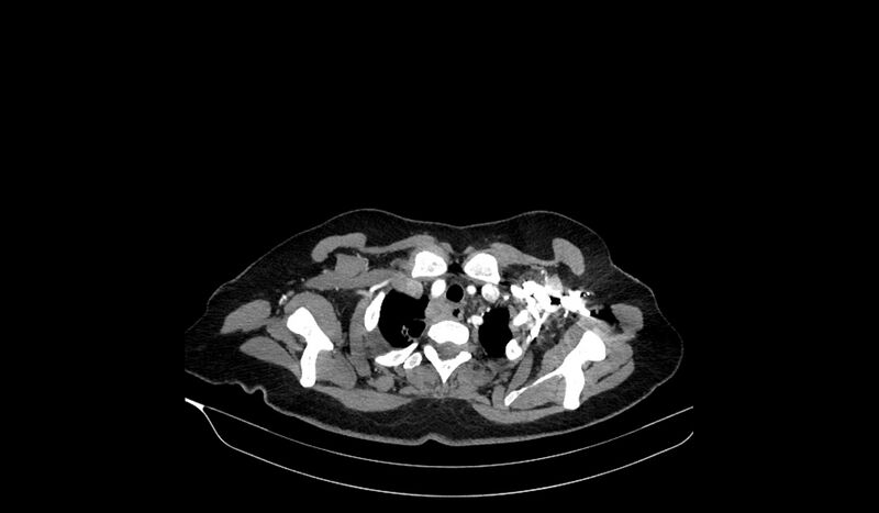File:Acquired tracheo-esophageal fistula (Radiopaedia 51356-57103 Axial C+ arterial phase 16).jpg