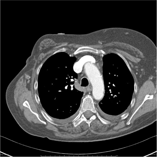 File:Acute-on-chronic pulmonary emboli (Radiopaedia 27925-28169 C+ CTPA 24).jpg