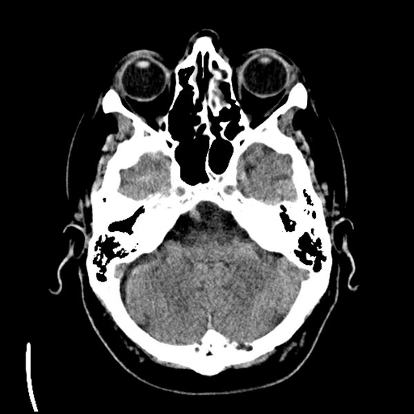 File:Acute A3 occlusion with ACA ischemic penumbra (CT perfusion) (Radiopaedia 72036-82525 Axial non-contrast 9).jpg