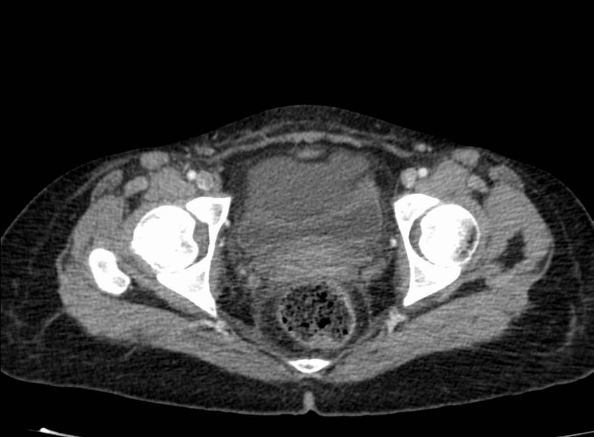 Acute Budd-Chiari syndrome (Radiopaedia 60858-68638 Axial C+ portal venous phase 282).jpg
